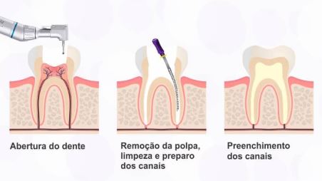 Alívio da dor com tratamento de canal - Real Odonto