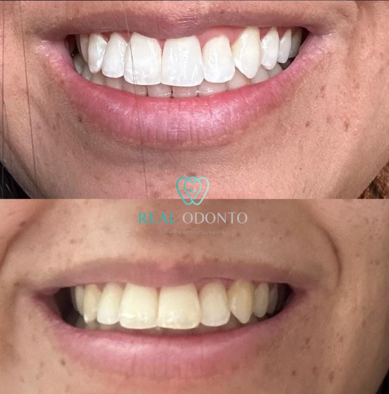 Clareamento dental em consultório - Real Odonto