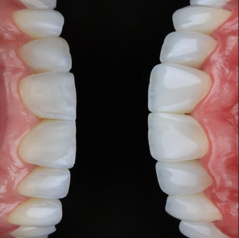 Facetas em Resina e Porcelana Real Odonto