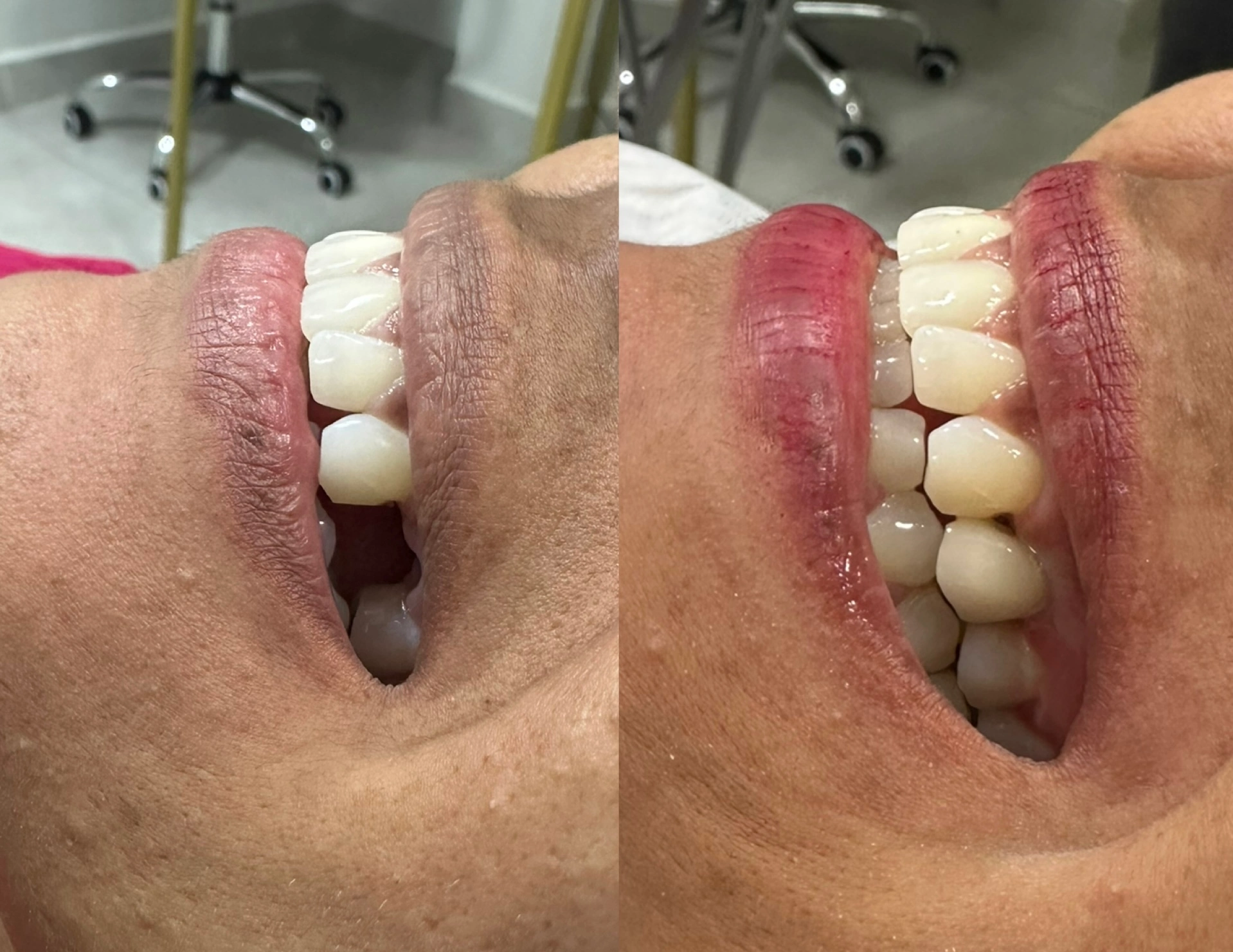 Implante unitário com resultado natural - Real Odonto