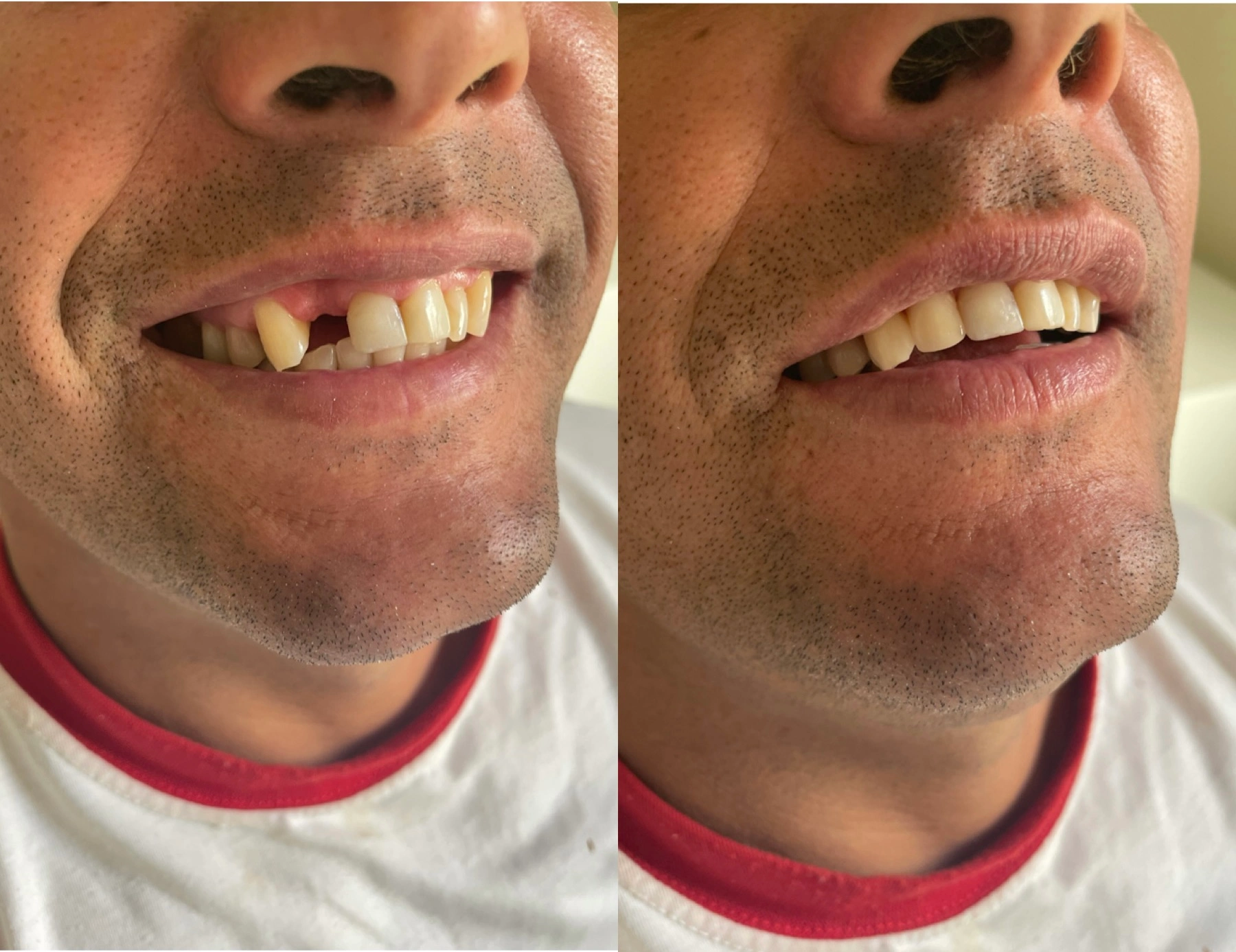 Coroa sobre implante unitário - Real Odonto