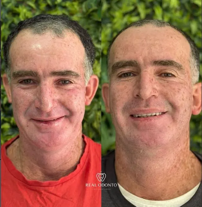Resultado de prótese protocolo - Real Odonto