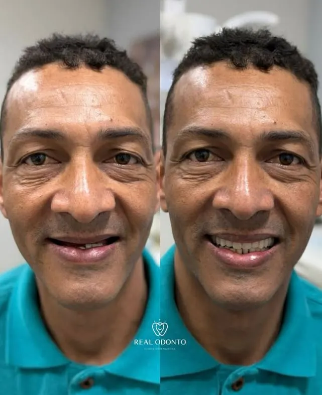 Dente fixo com prótese protocolo - Real Odonto