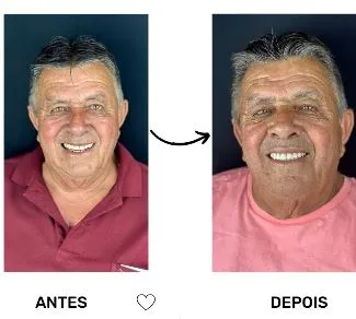 Dentadura fixa sobre implantes - Real Odonto