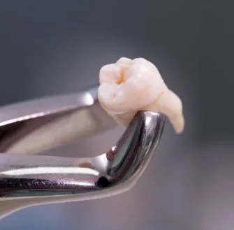 Extração de siso na Real Odonto