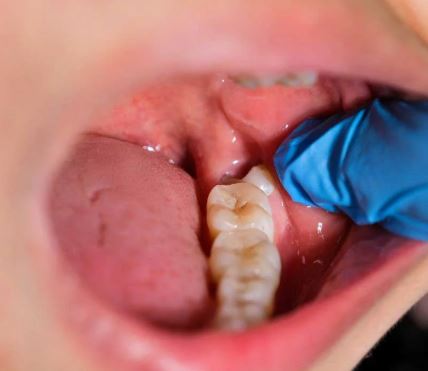 Avaliação para extração de siso - Real Odonto