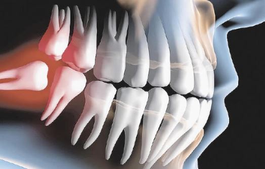 Remoção do dente do siso com segurança - Real Odonto